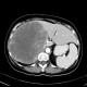 Metastasis of tubular carcinoma of large bowel, colorectal carcinoma, hemihepatectomy: CT - Computed tomography